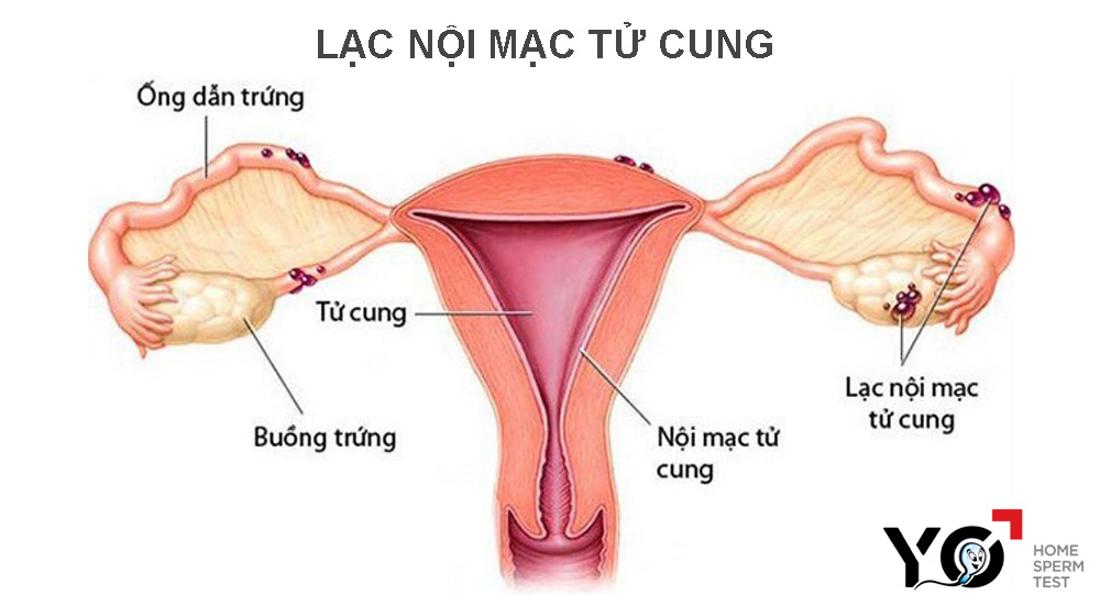 Lạc nội mạc tử cung nếu không điều trị kịp thời có thể gây vô sinh nữ