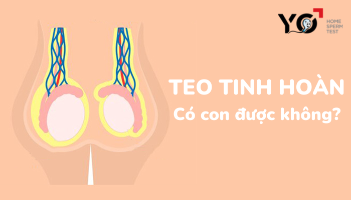 Teo tinh hoàn có con được không