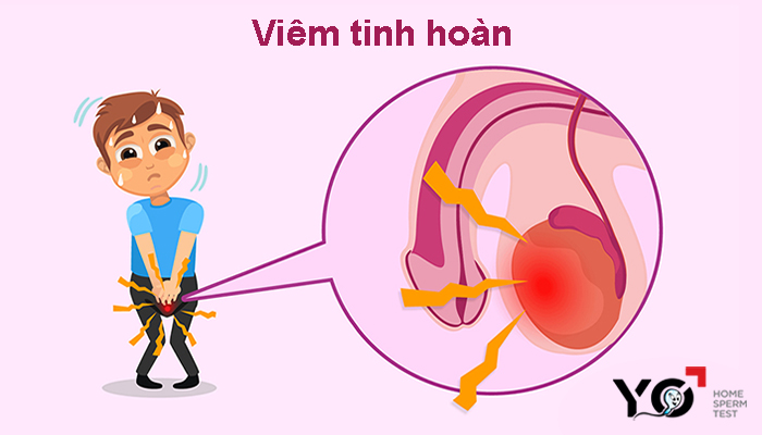 Viêm tinh hoàn