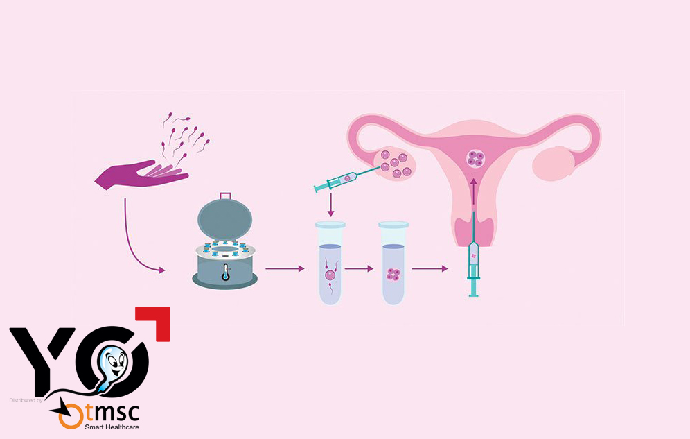 Phương pháp sàng lọc và thụ tinh trong ống nghiệm (IVF)