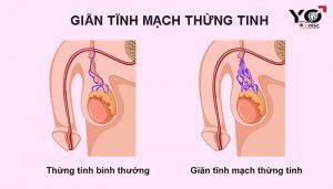 Giãn tĩnh mạch thừng tinh