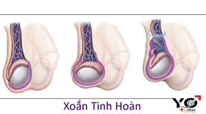 xoắn tinh hoàn