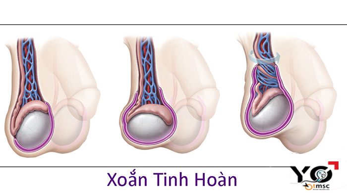xoắn tinh hoàn