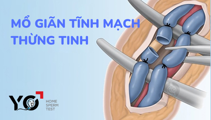 MỔ GIÃN TĨNH MẠCH THỪNG TINH