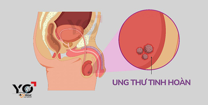 ung thu tinh hoan 1