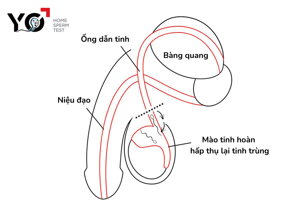 Mào tinh hoàn hấp thụ lại tinh trùng sau thắt ống dẫn tinh