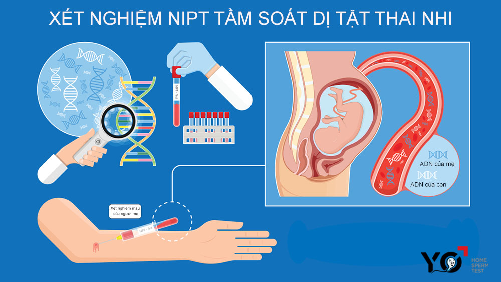 Xét nghiệm NIPT giúp tầm soát dị tật sớm ở thai nhi
