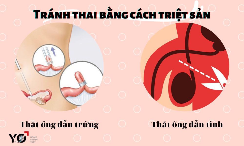 Tránh thai bằng phương pháp triệt sản