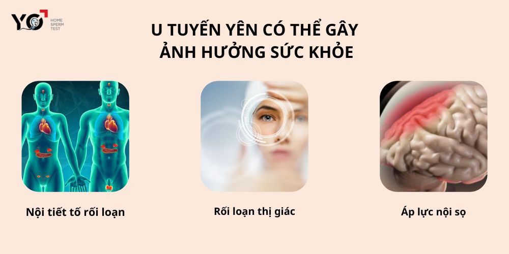 U tuyến yên gây ra hậu quả xấu